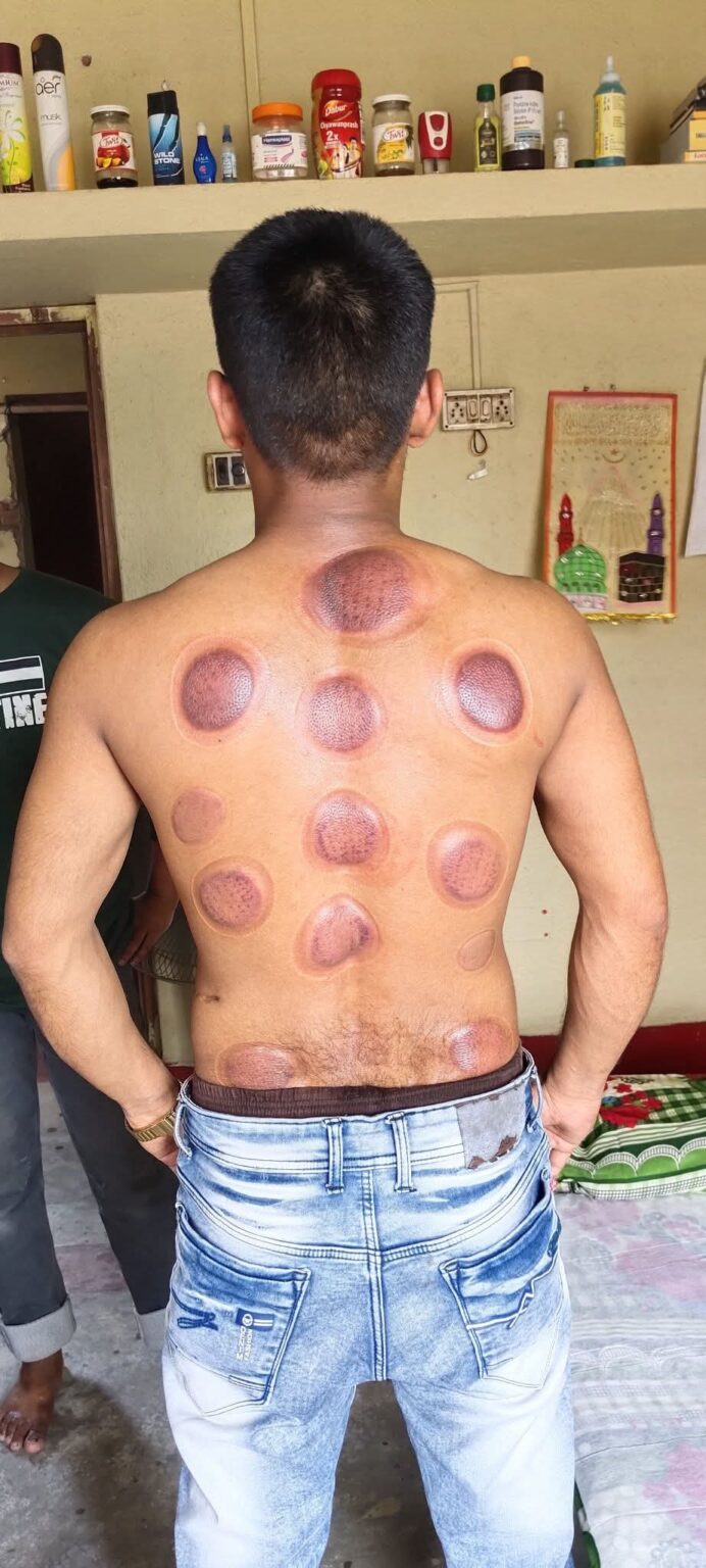 hijama